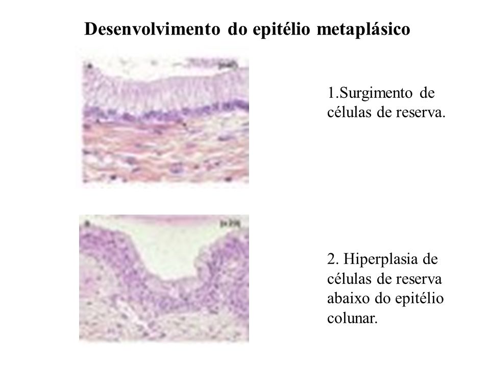 Desenvolvimento do epitélio metaplásico