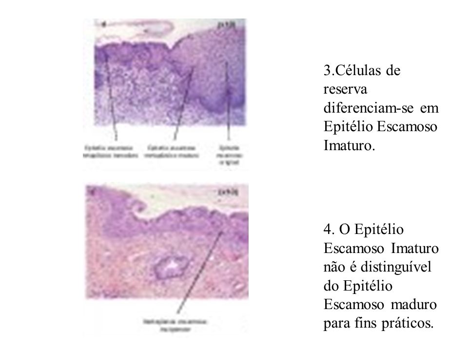 3.Células de reserva diferenciam-se em Epitélio Escamoso Imaturo.
