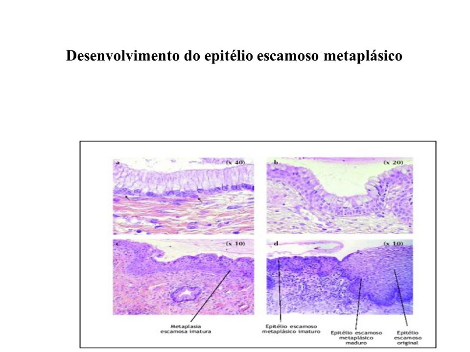 Desenvolvimento do epitélio escamoso metaplásico
