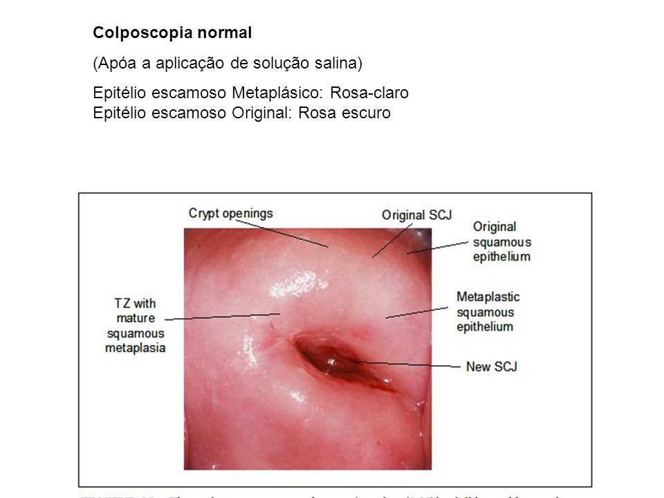 Colposcopia normal (Apóa a aplicação de solução salina)