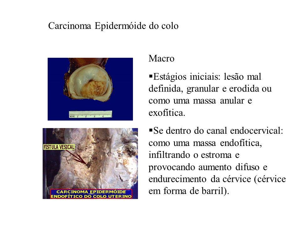 Carcinoma Epidermóide do colo