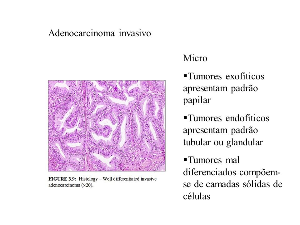 Adenocarcinoma invasivo