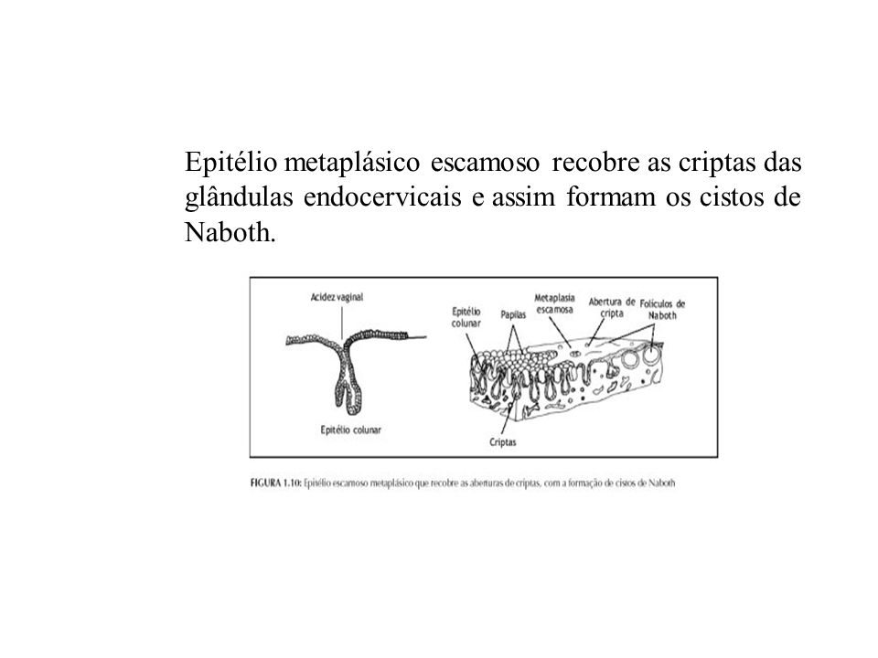Epitélio metaplásico escamoso recobre as criptas das glândulas endocervicais e assim formam os cistos de Naboth.