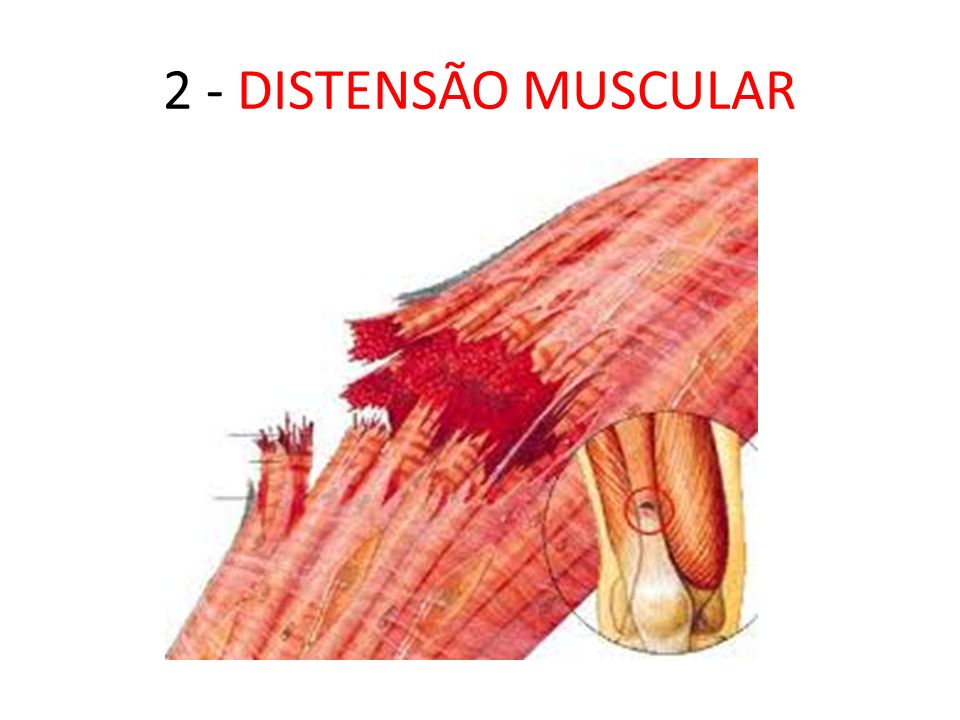 2 - DISTENSÃO MUSCULAR