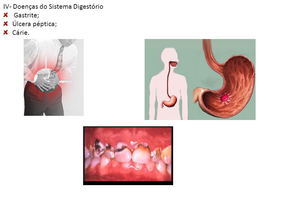 IV- Doenças do Sistema Digestório