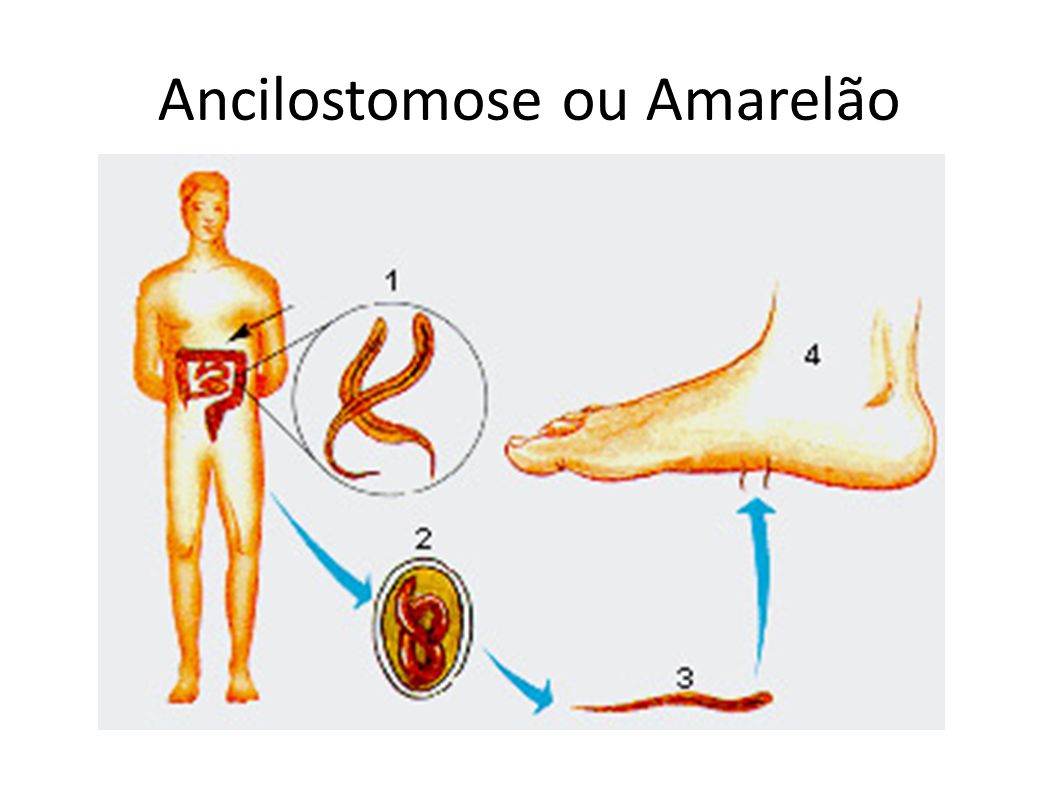 Ancilostomose ou Amarelão
