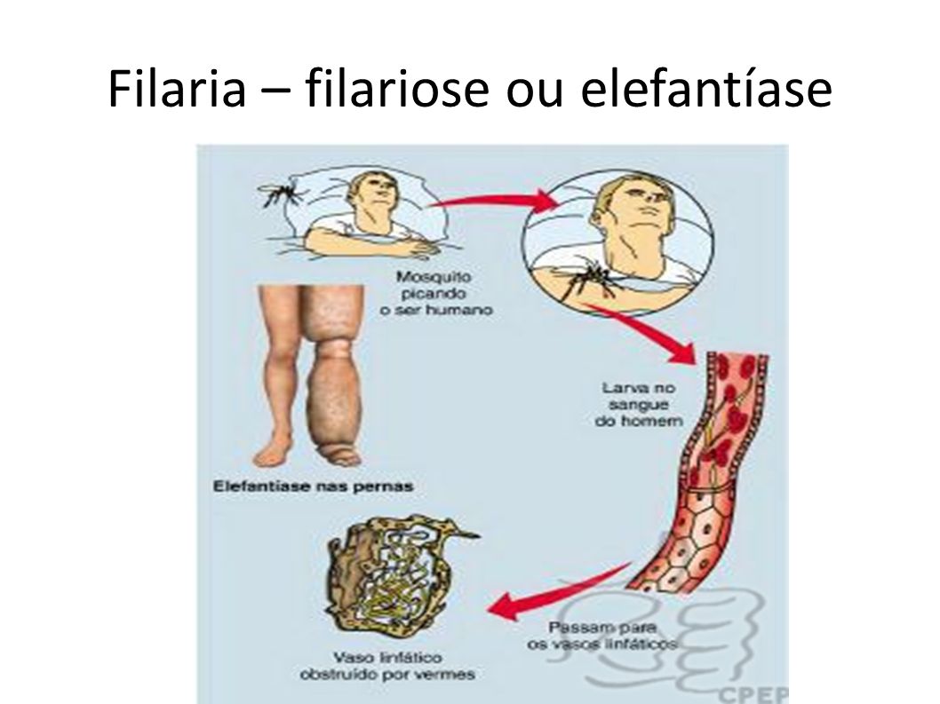 Filaria – filariose ou elefantíase