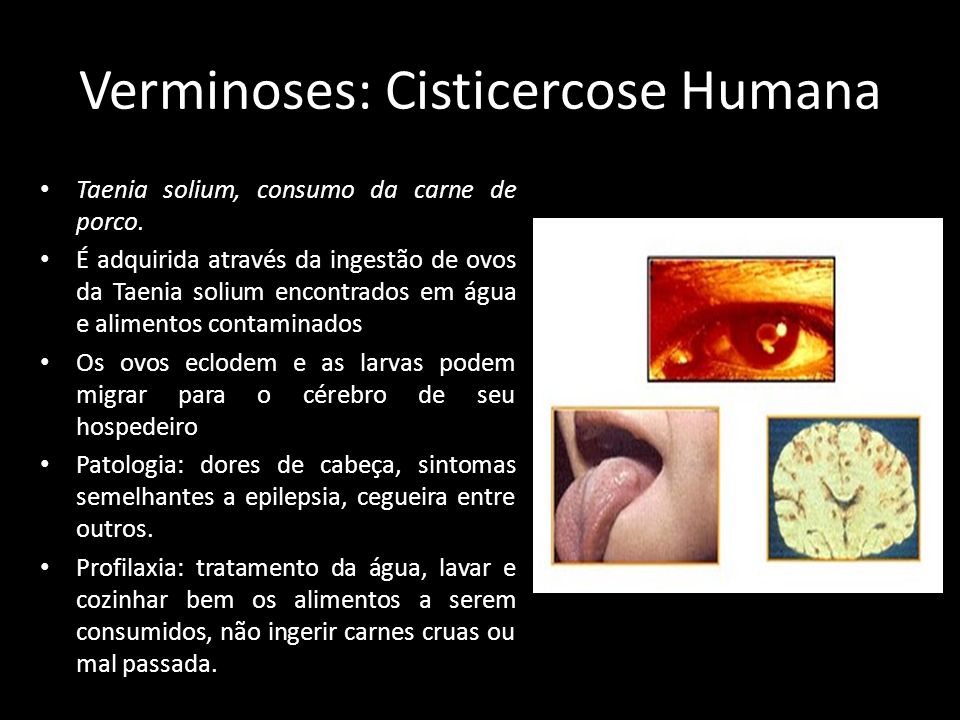 Verminoses: Cisticercose Humana