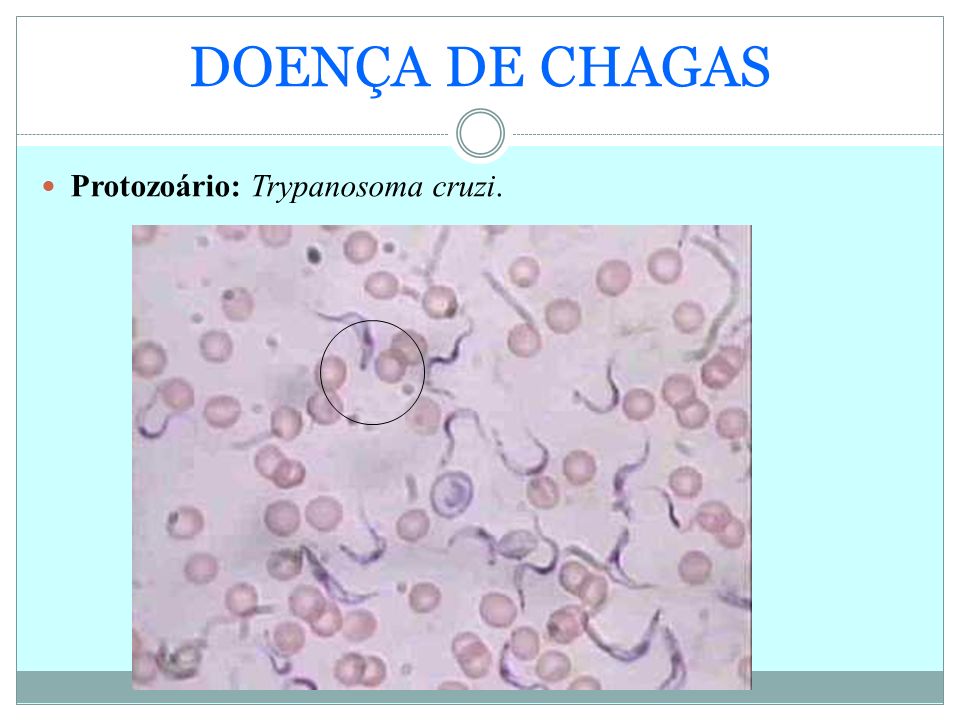 DOENÇA DE CHAGAS Protozoário: Trypanosoma cruzi.