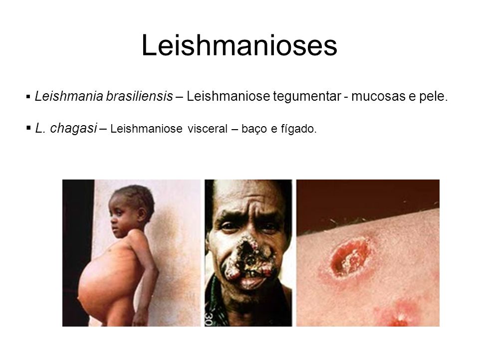 Leishmanioses L. chagasi – Leishmaniose visceral – baço e fígado.