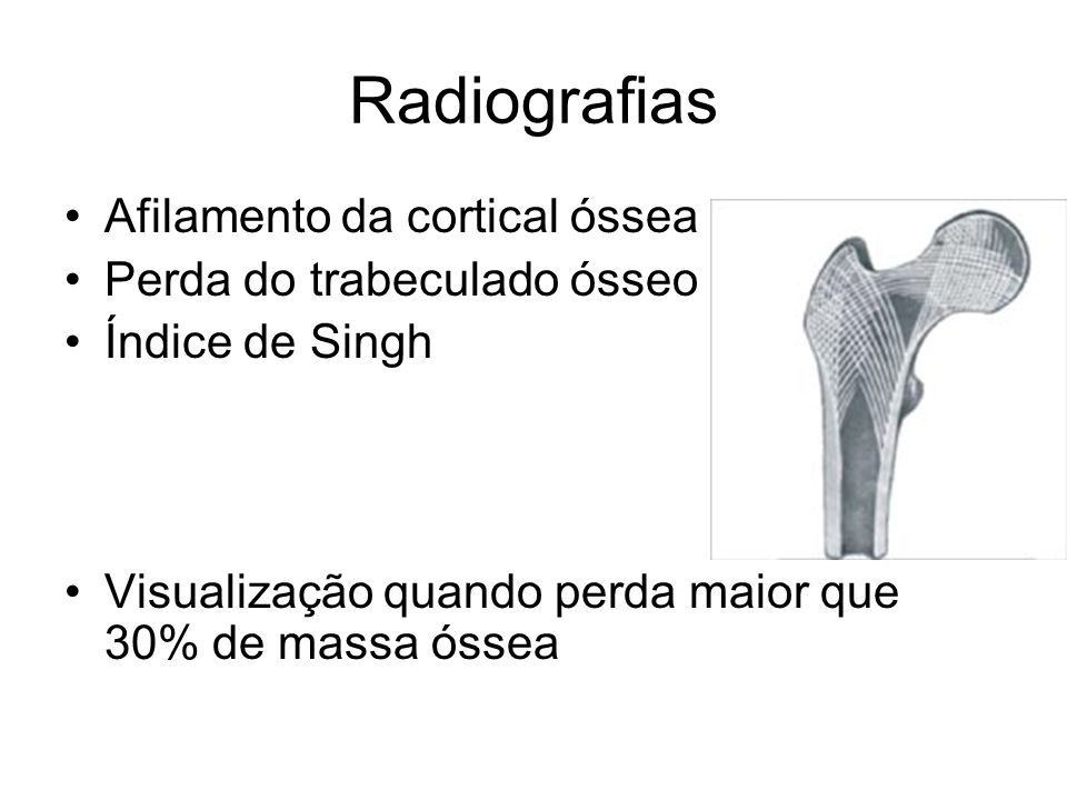 Radiografias Afilamento da cortical óssea Perda do trabeculado ósseo