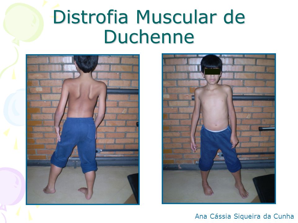 Distrofia Muscular de Duchenne
