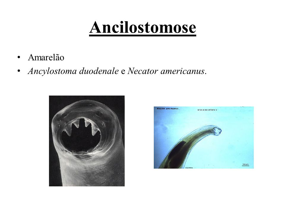 Ancilostomose Amarelão Ancylostoma duodenale e Necator americanus.