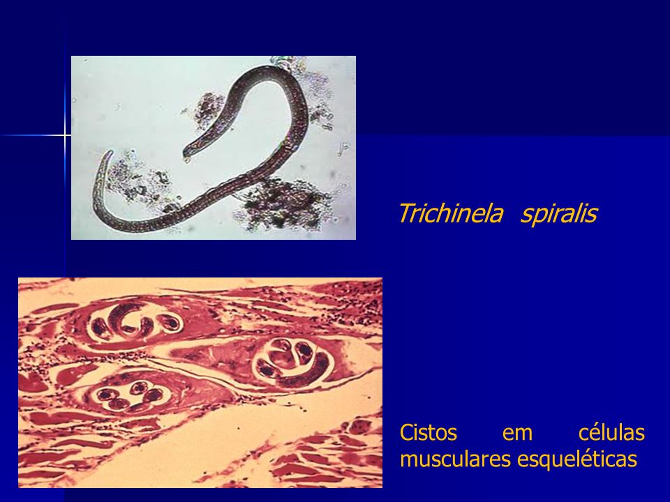 Trichinela spiralis Cistos em células musculares esqueléticas