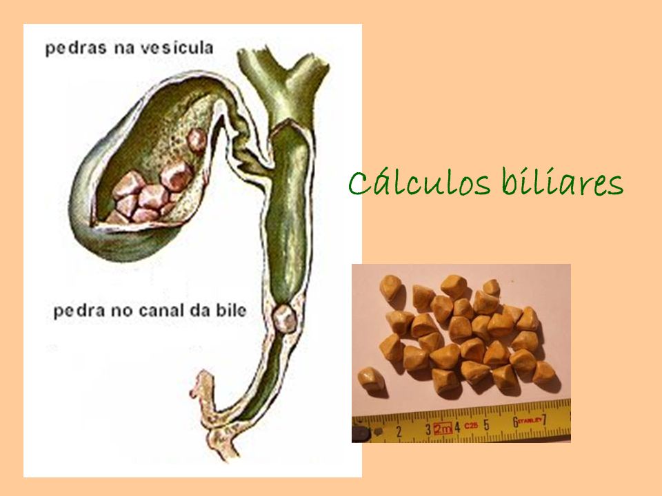 Cálculos biliares