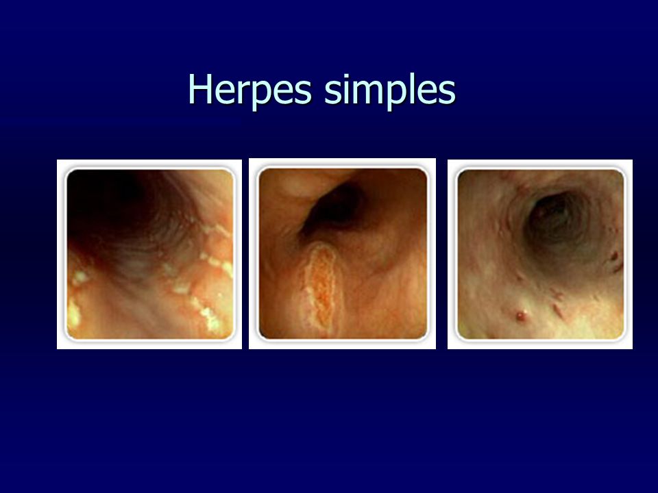 Herpes simples