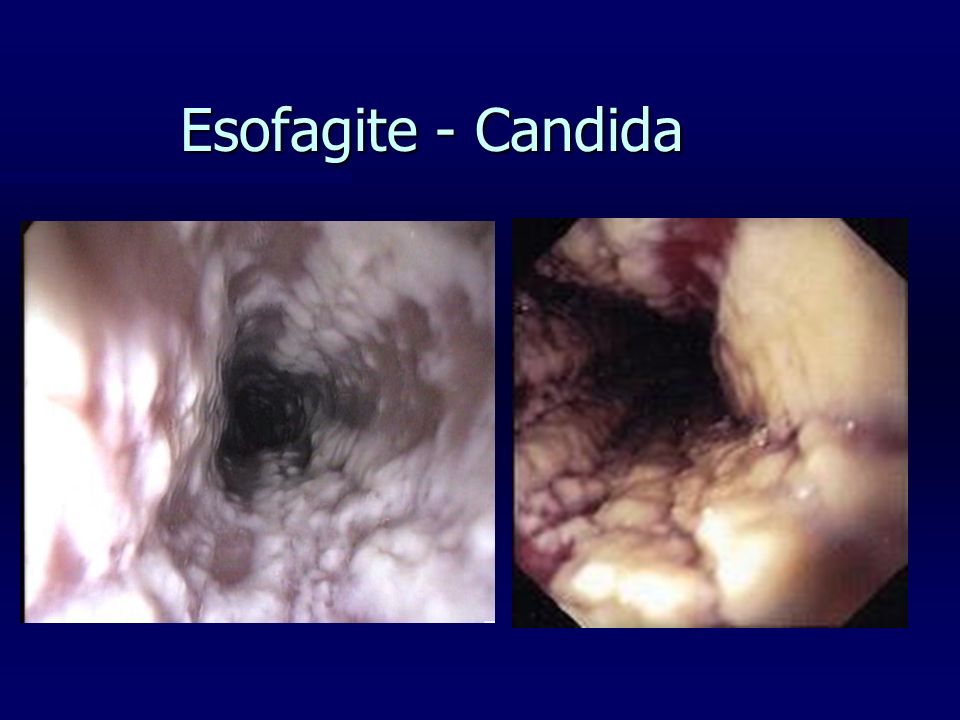 Esofagite - Candida