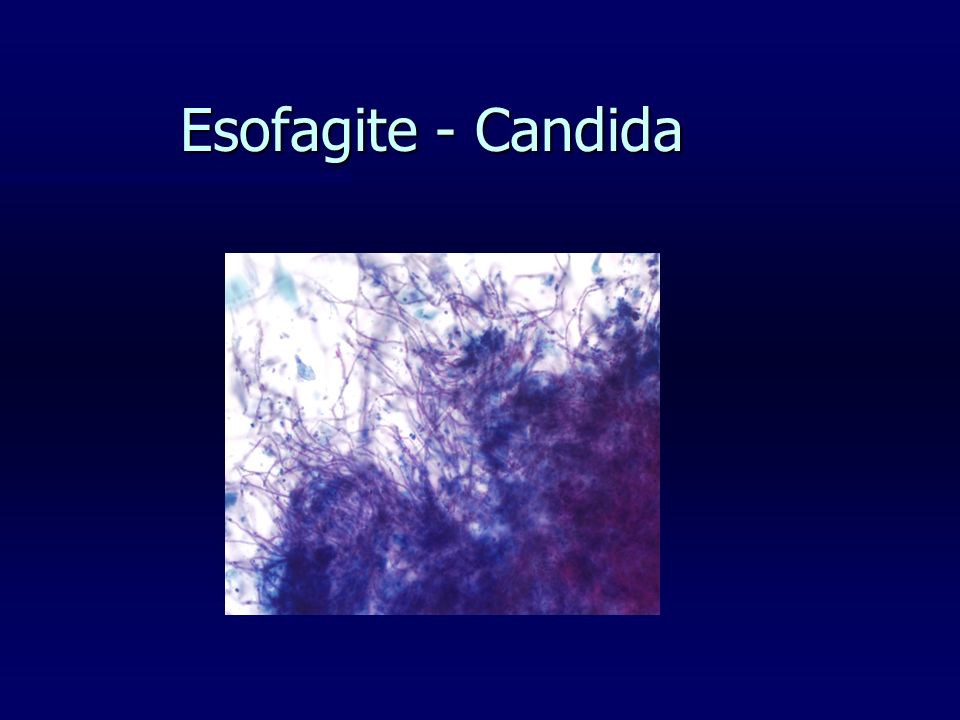 Esofagite - Candida
