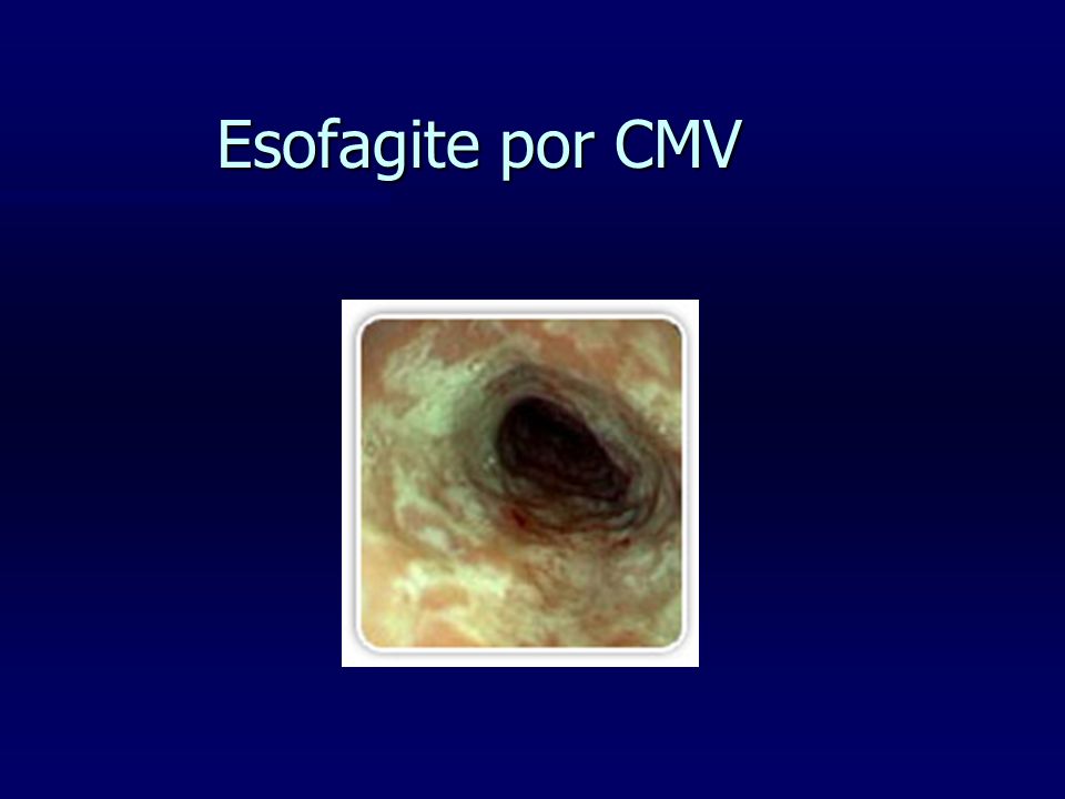 Esofagite por CMV
