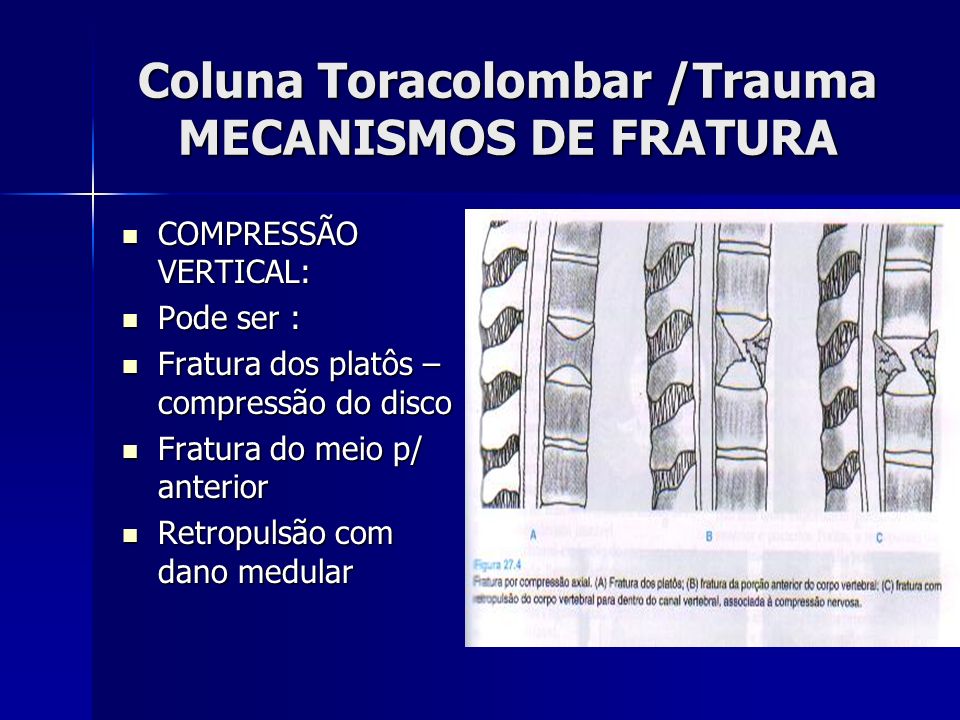 Coluna Toracolombar /Trauma MECANISMOS DE FRATURA