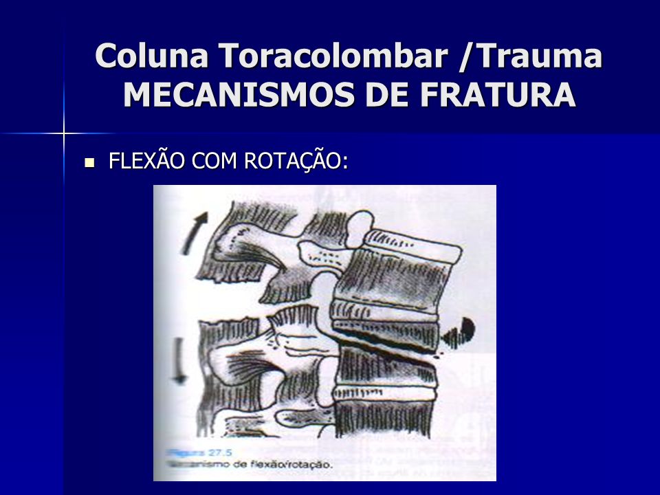Coluna Toracolombar /Trauma MECANISMOS DE FRATURA