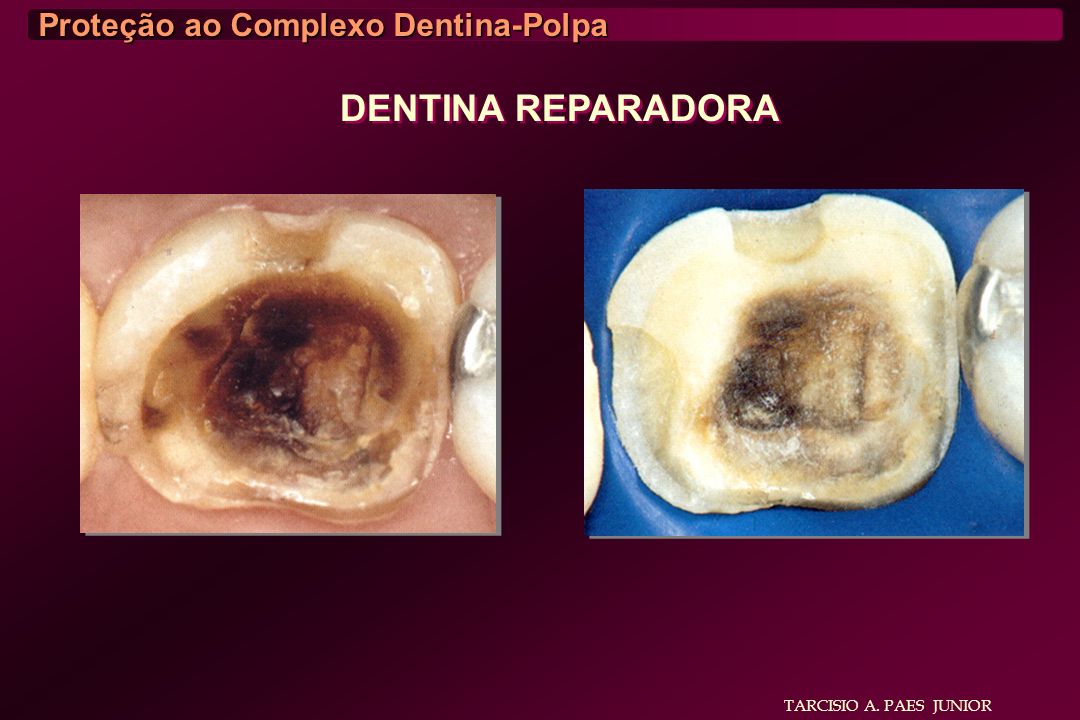 DENTINA REPARADORA Proteção ao Complexo Dentina-Polpa