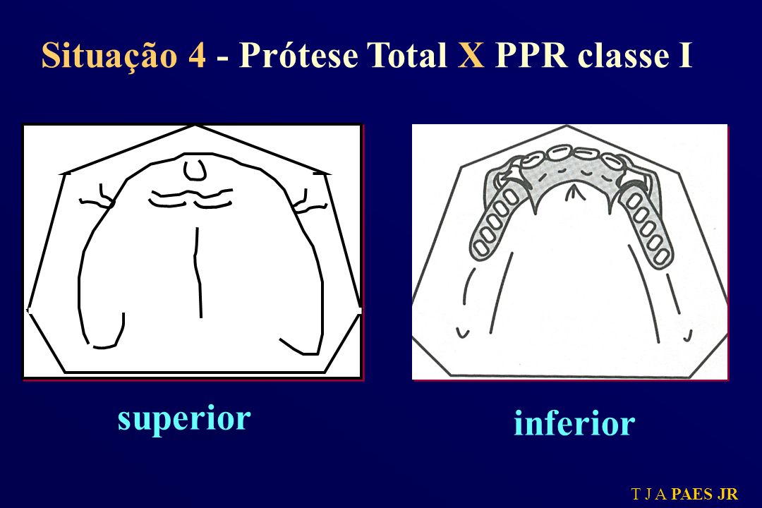 Situação 4 - Prótese Total X PPR classe I