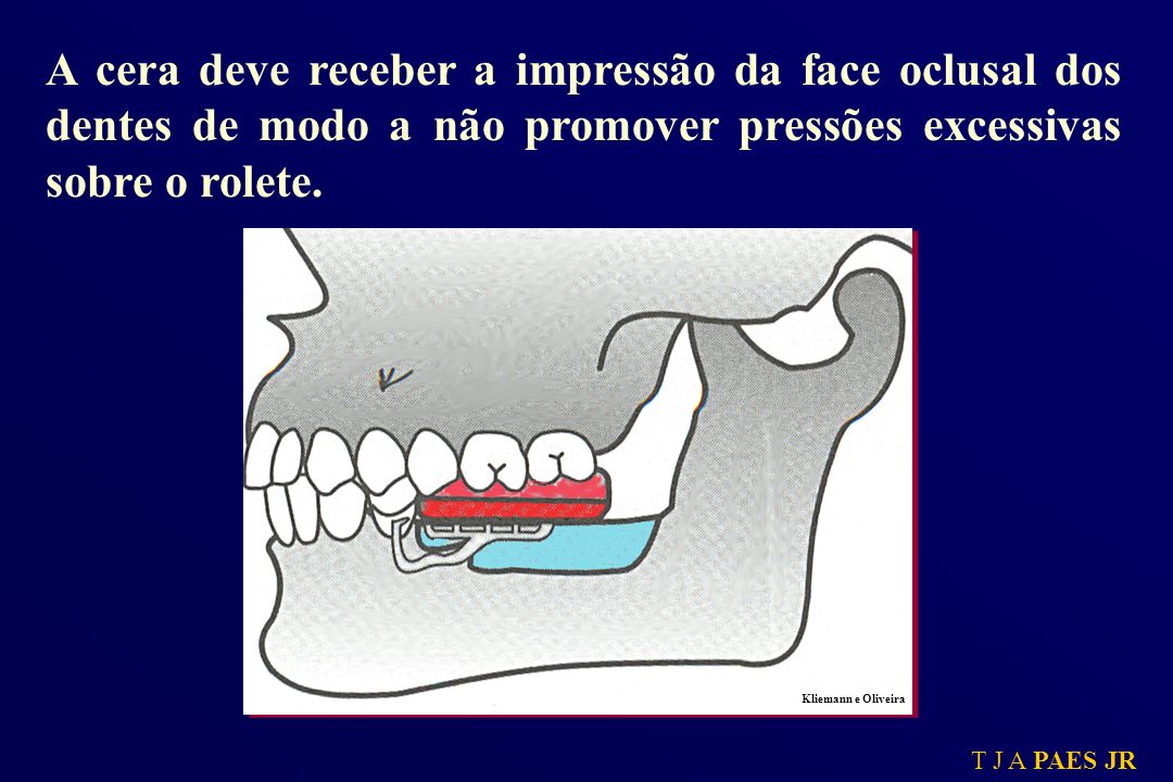 A cera deve receber a impressão da face oclusal dos dentes de modo a não promover pressões excessivas sobre o rolete.