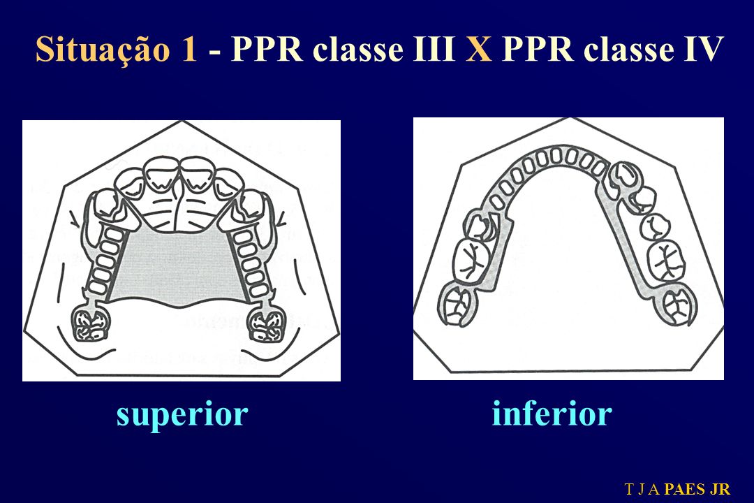 Situação 1 - PPR classe III X PPR classe IV