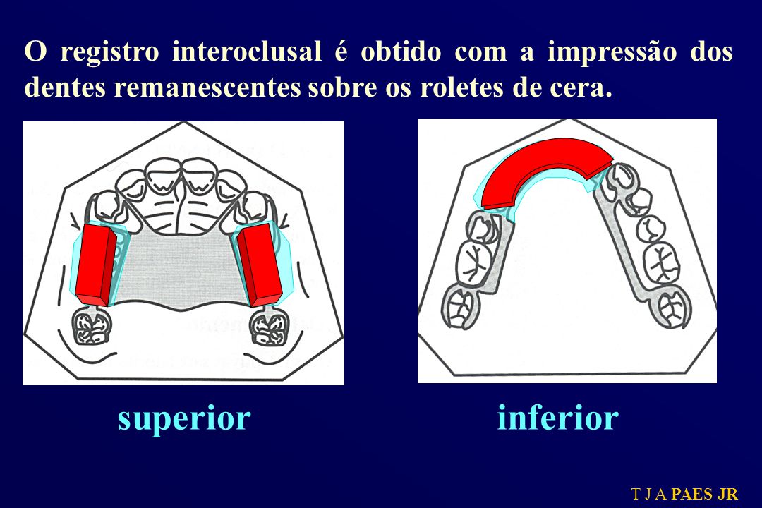 O registro interoclusal é obtido com a impressão dos dentes remanescentes sobre os roletes de cera.