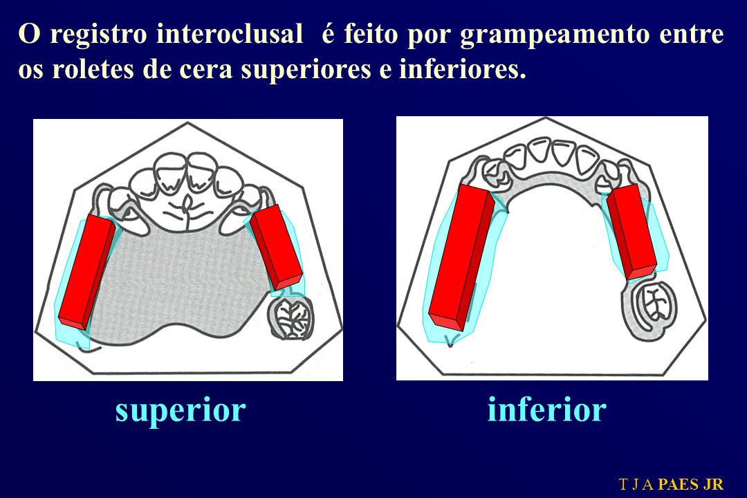 O registro interoclusal é feito por grampeamento entre os roletes de cera superiores e inferiores.