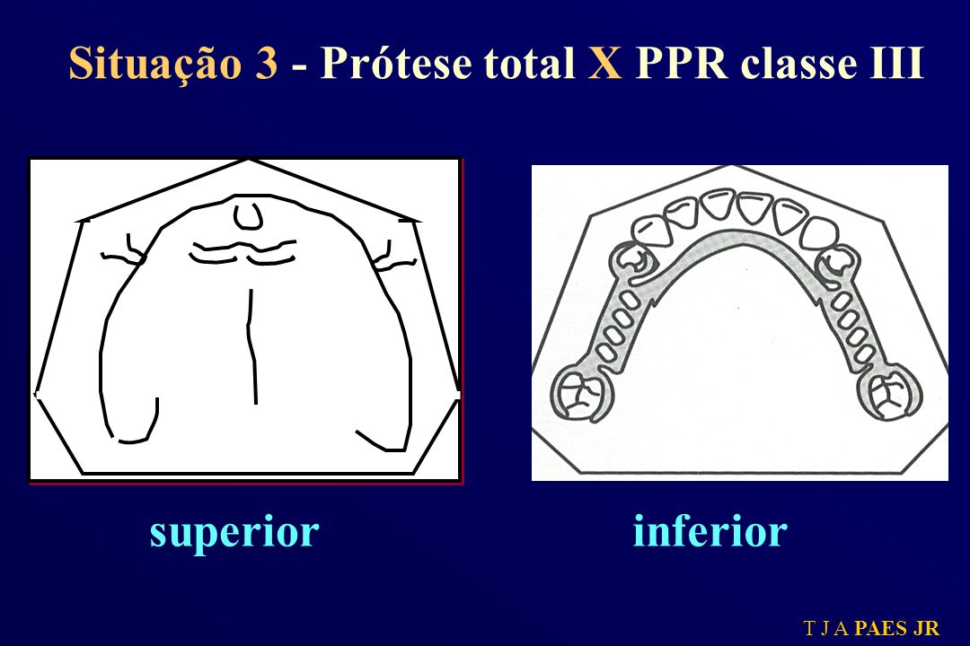 Situação 3 - Prótese total X PPR classe III