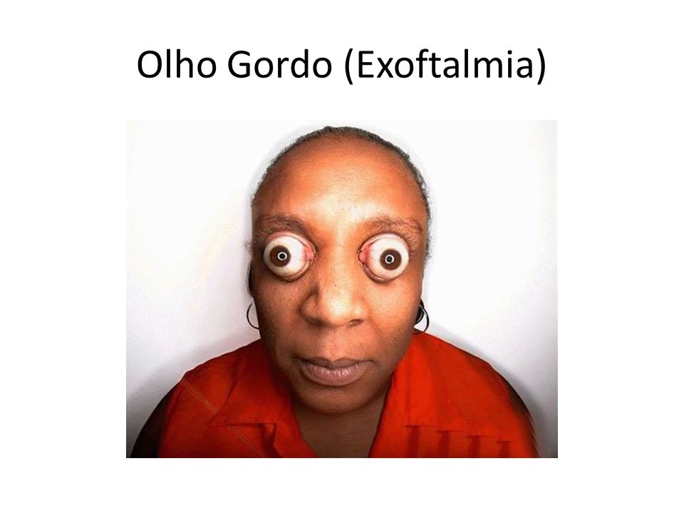 Olho Gordo (Exoftalmia)