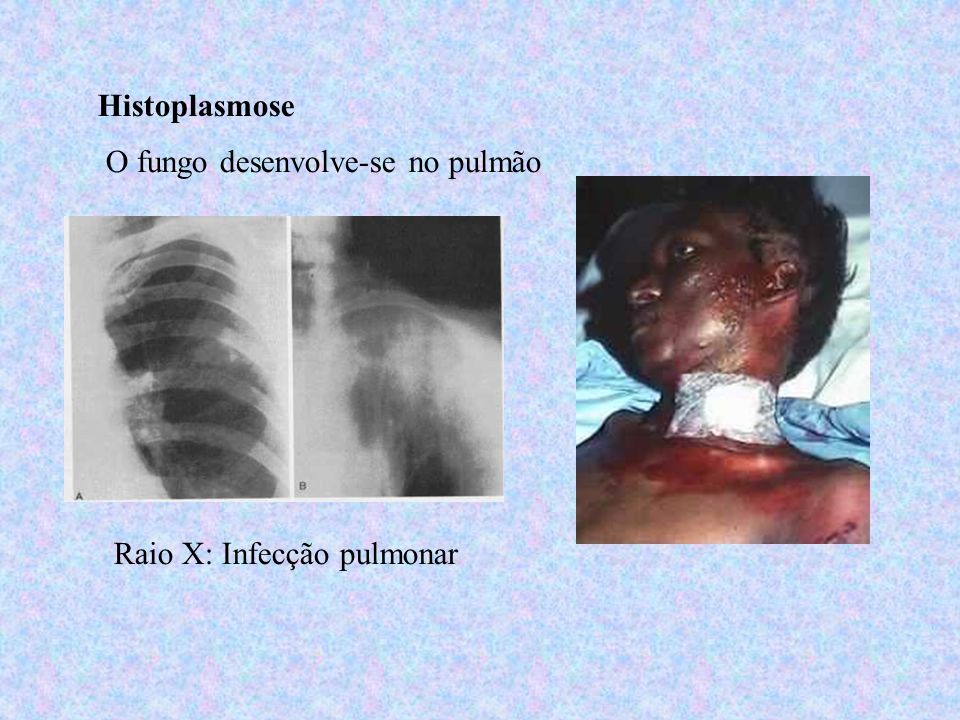 Histoplasmose O fungo desenvolve-se no pulmão Raio X: Infecção pulmonar