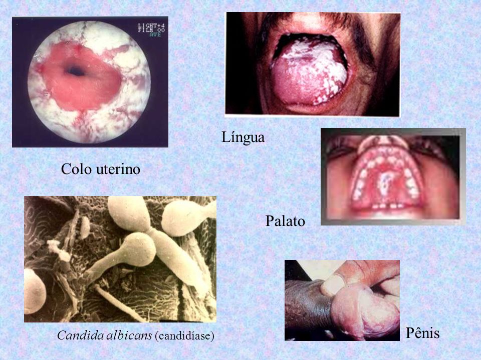 Língua Colo uterino Palato Pênis Candida albicans (candidíase)‏