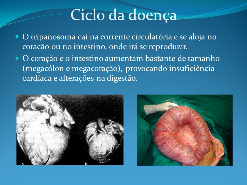 Ciclo da doença O tripanosoma cai na corrente circulatória e se aloja no coração ou no intestino, onde irá se reproduzir.