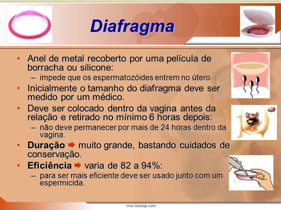 Diafragma Anel de metal recoberto por uma película de borracha ou silicone: impede que os espermatozóides entrem no útero.