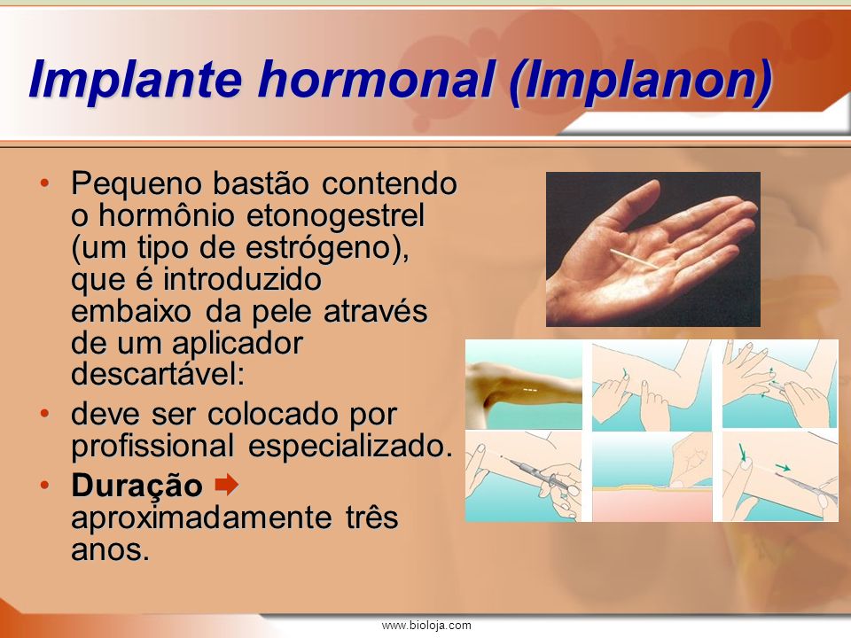 Implante hormonal (Implanon)