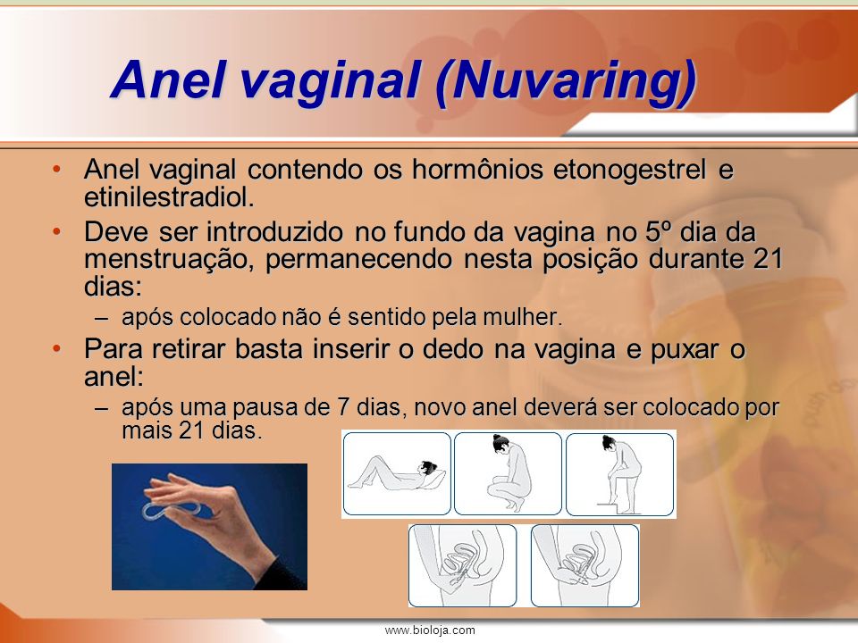 Anel vaginal (Nuvaring)