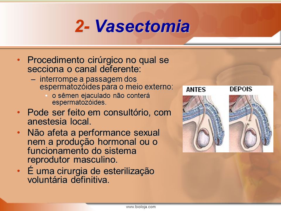 2- Vasectomia Procedimento cirúrgico no qual se secciona o canal deferente: interrompe a passagem dos espermatozóides para o meio externo:
