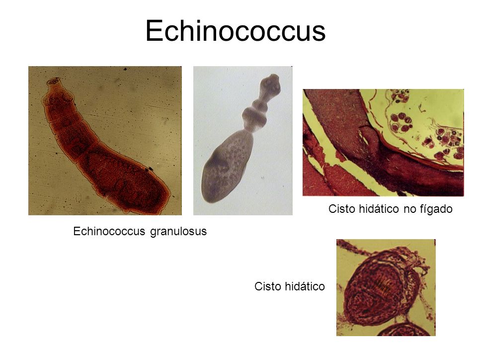 Echinococcus Cisto hidático no fígado Echinococcus granulosus