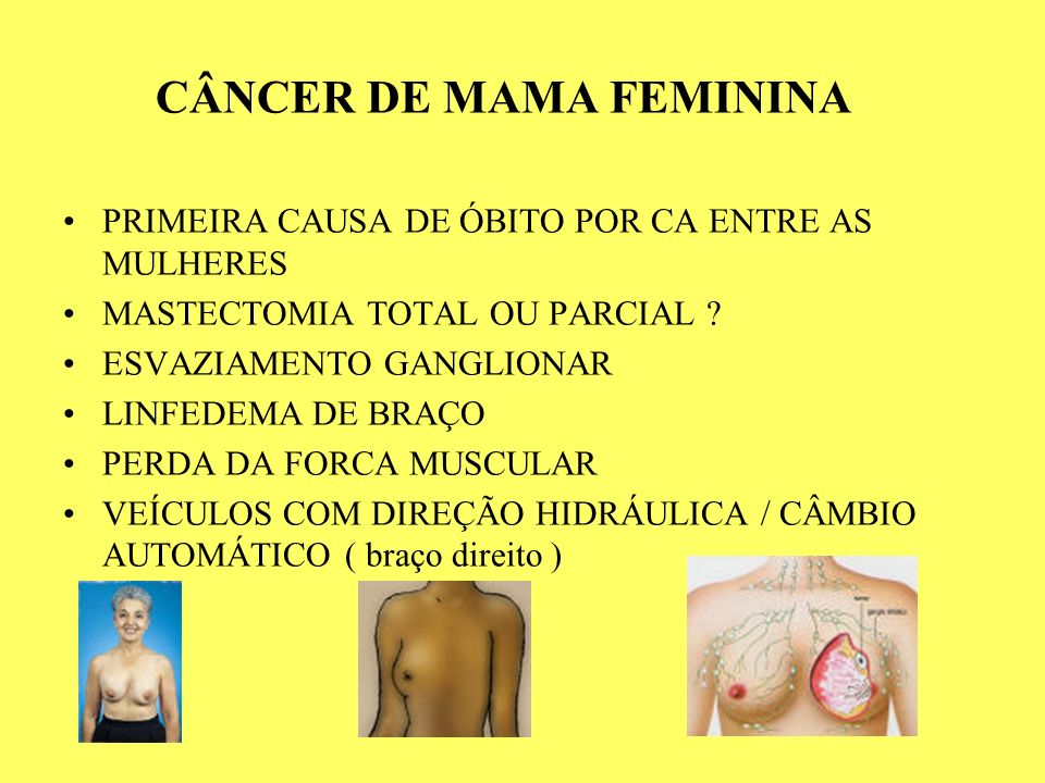 CÂNCER DE MAMA FEMININA