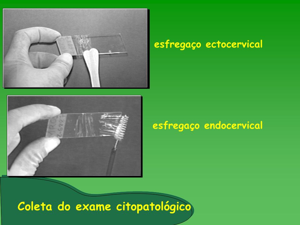esfregaço ectocervical esfregaço endocervical