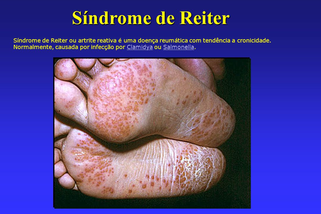 sindromul reiter tratarea artrozei cu argilă albastră