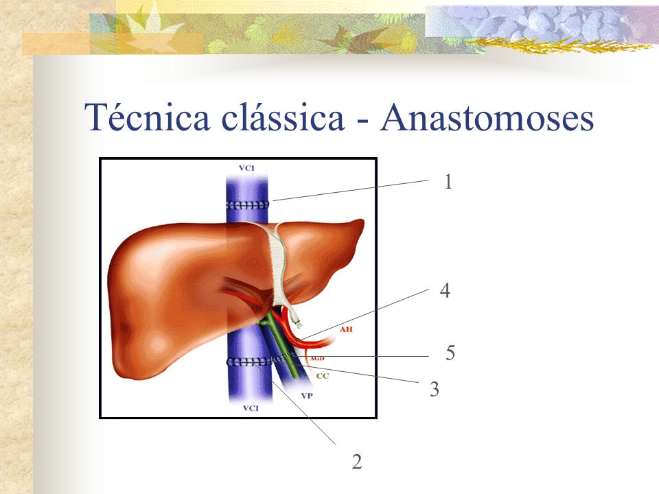 Técnica clássica - Anastomoses