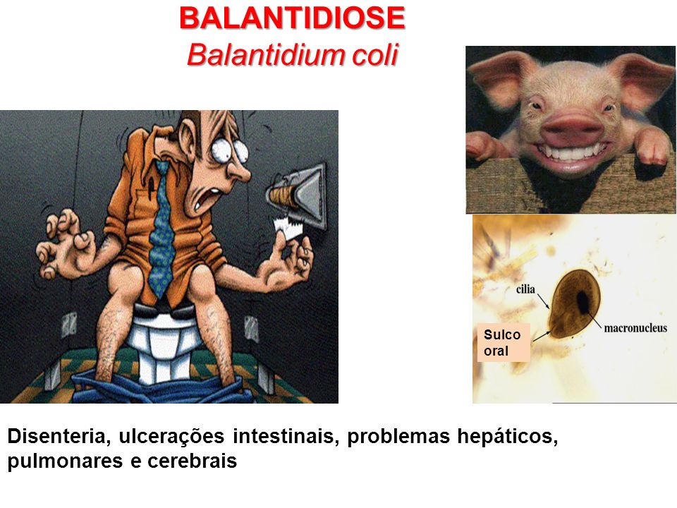 BALANTIDIOSE Balantidium coli