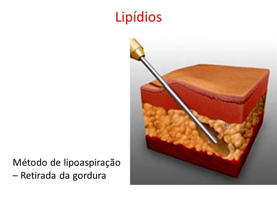 Lipídios Método de lipoaspiração – Retirada da gordura