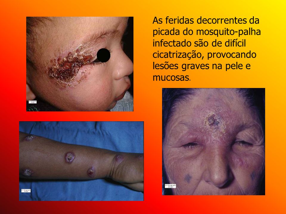 As feridas decorrentes da picada do mosquito-palha infectado são de difícil cicatrização, provocando lesões graves na pele e mucosas.