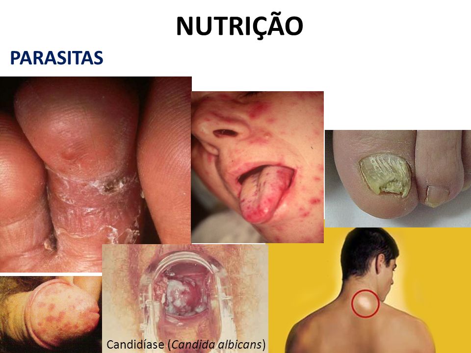NUTRIÇÃO PARASITAS Candidíase (Candida albicans)