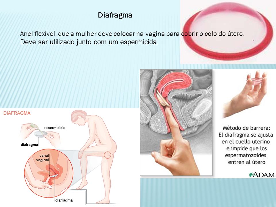 Diafragma Anel flexível, que a mulher deve colocar na vagina para cobrir o colo do útero.